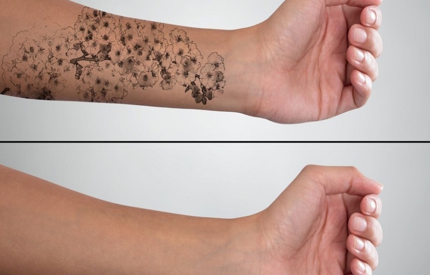 Risks Of Laser Tattoo Removal